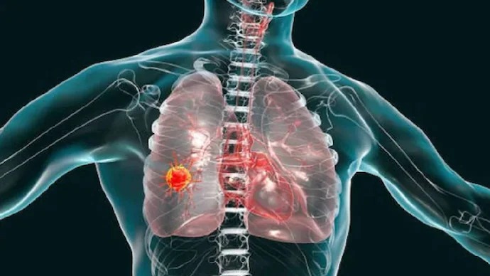 Stage 4 Lung Cancer: How Treatment Can Help and What Patients Should Know